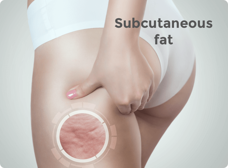 Cellulite - Subcutaneous fat