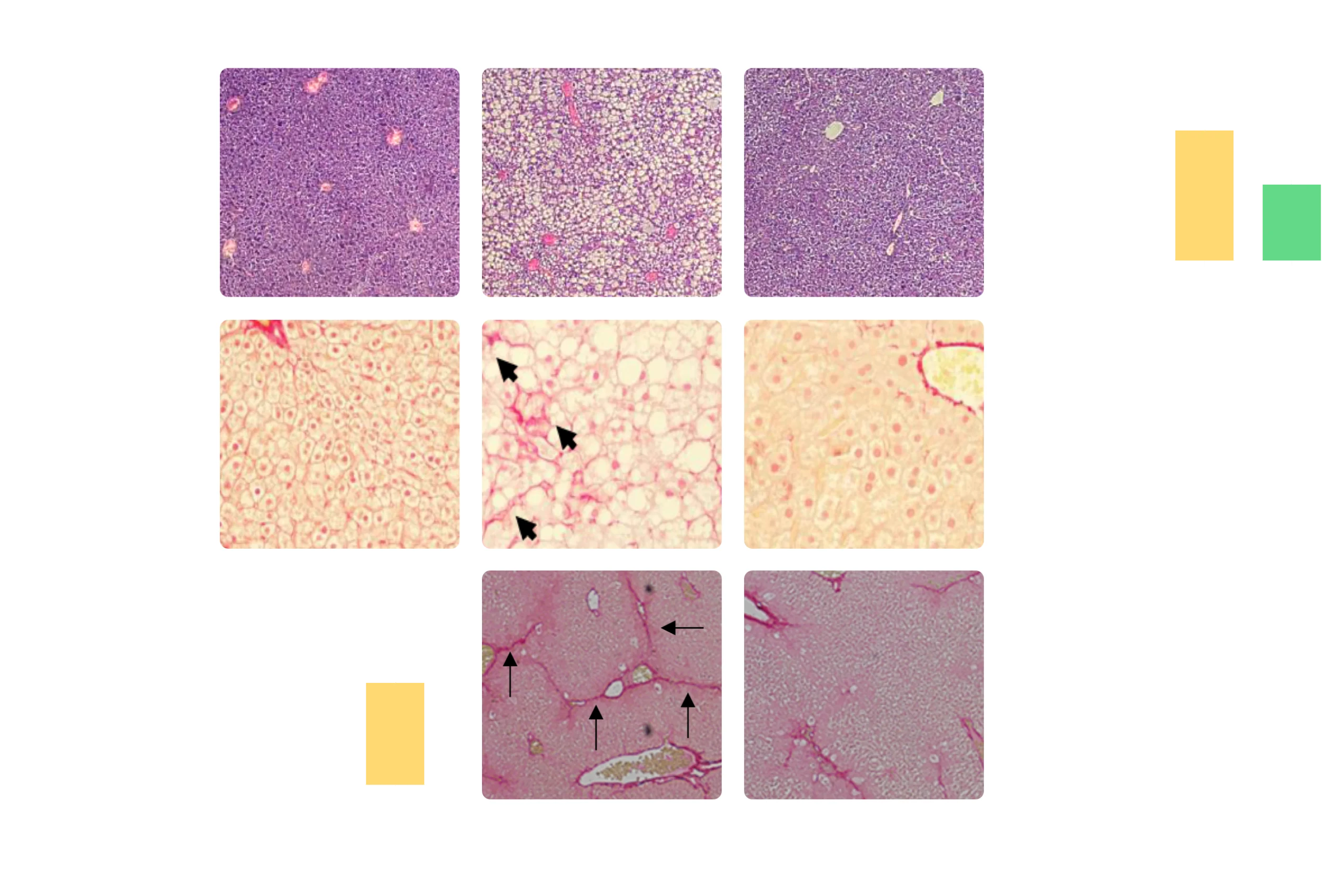 Chart: Steatosis, Fibrosis